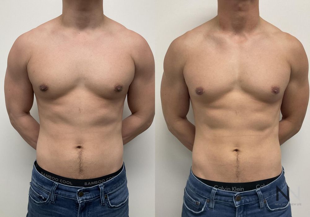 Gynecomastia - Case 2280