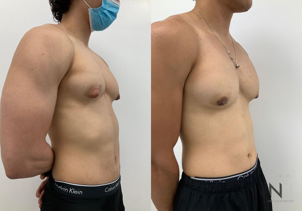 Gynecomastia - Thumbnail 2