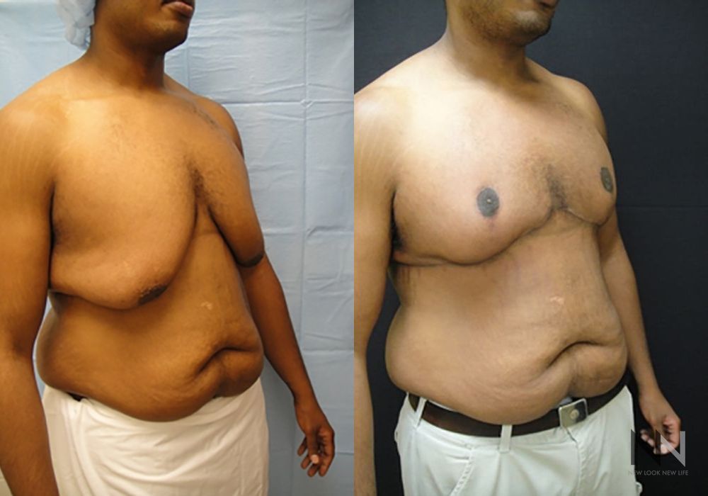 Gynecomastia - Thumbnail 4