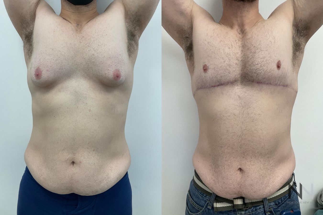 Before and after gynecomastia lift showing reduced male breast tissue and improved chest contour four months after surgery. - Angle 2