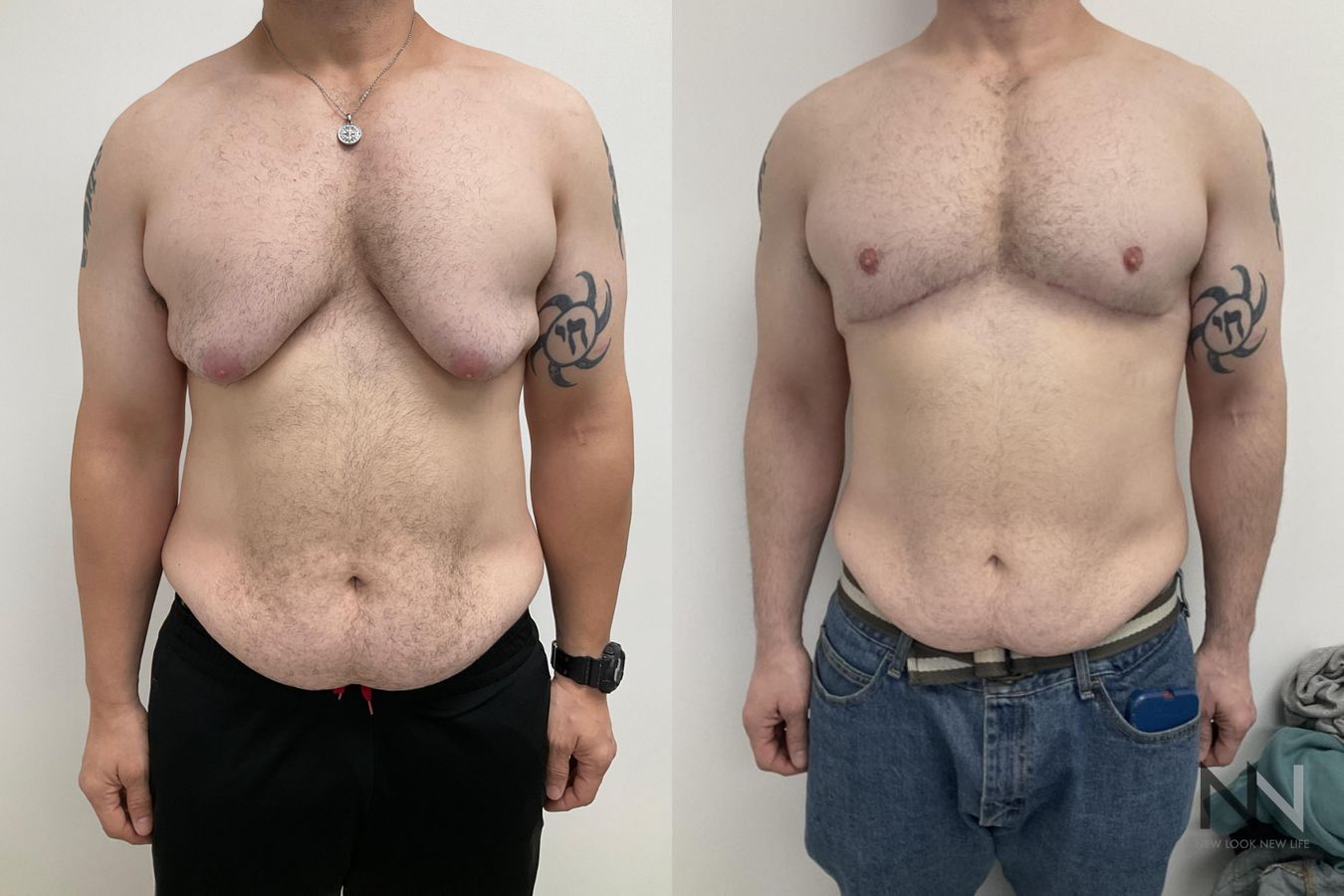 Before and after gynecomastia lift showing reduced male breast tissue and improved chest contour four months after surgery.