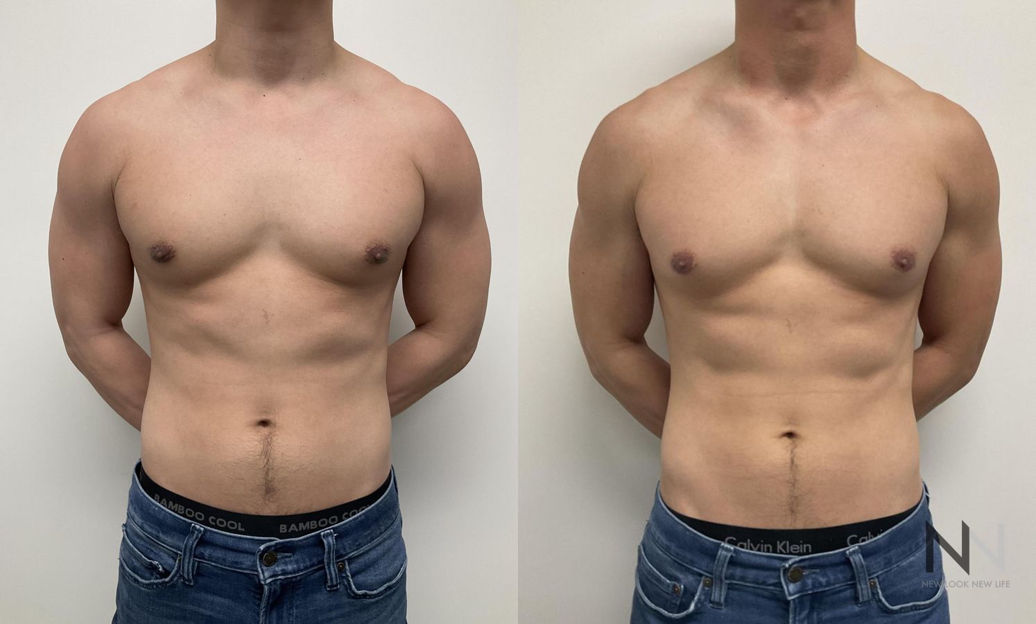 Gynecomastia surgery showing flatter chest contour - Angle 2