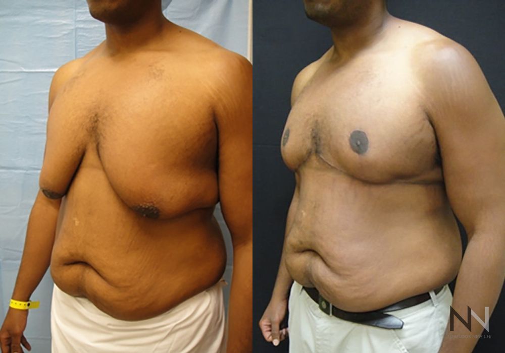 Gynecomastia - Thumbnail 2