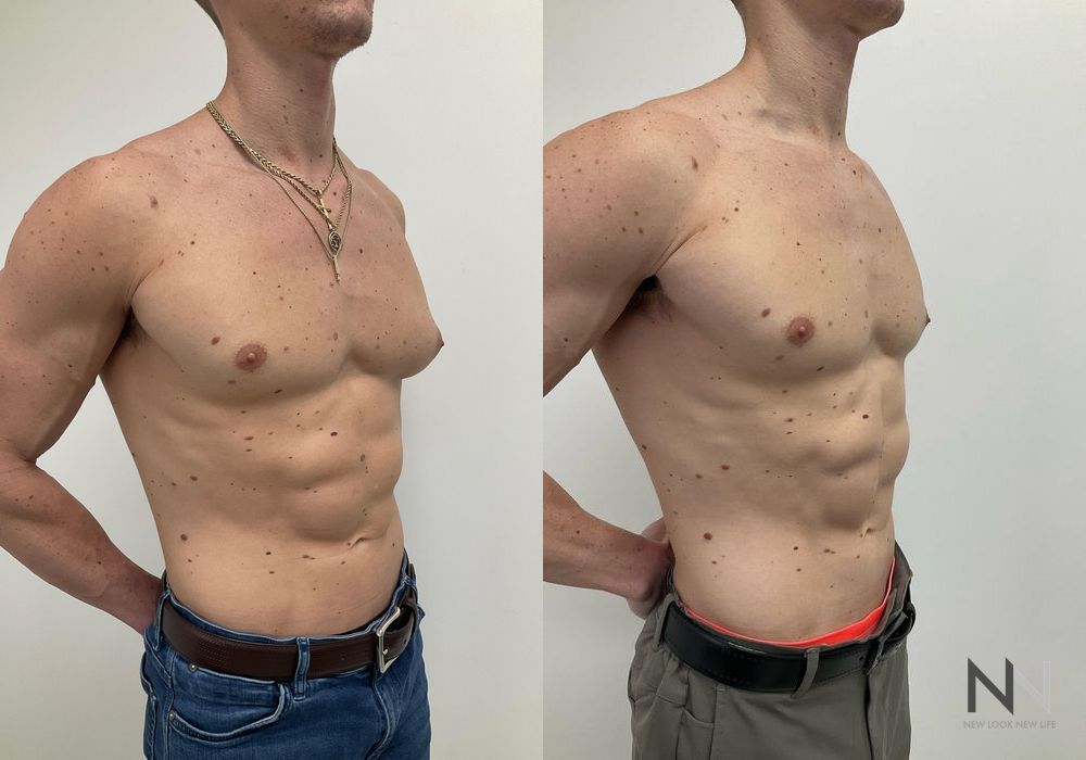 Gynecomastia - Thumbnail 2