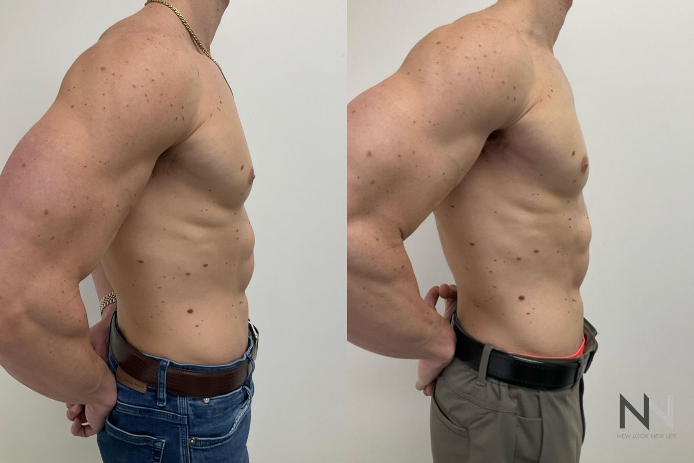 Gynecomastia before and after frontal view comparison - Angle 3