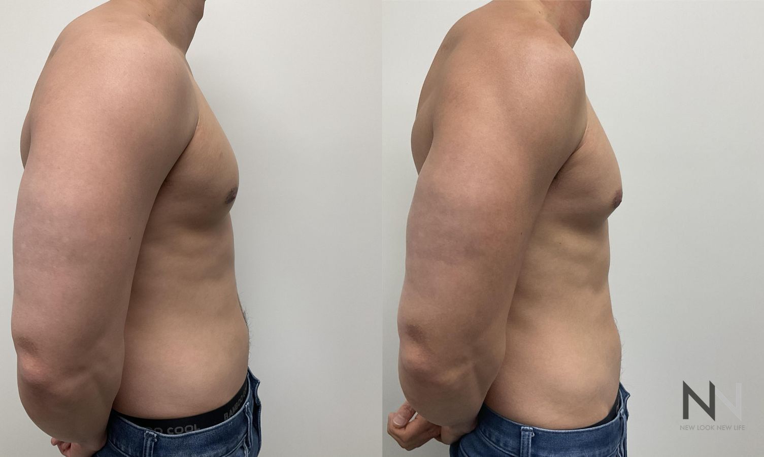 Gynecomastia surgery showing flatter chest contour - Angle 6