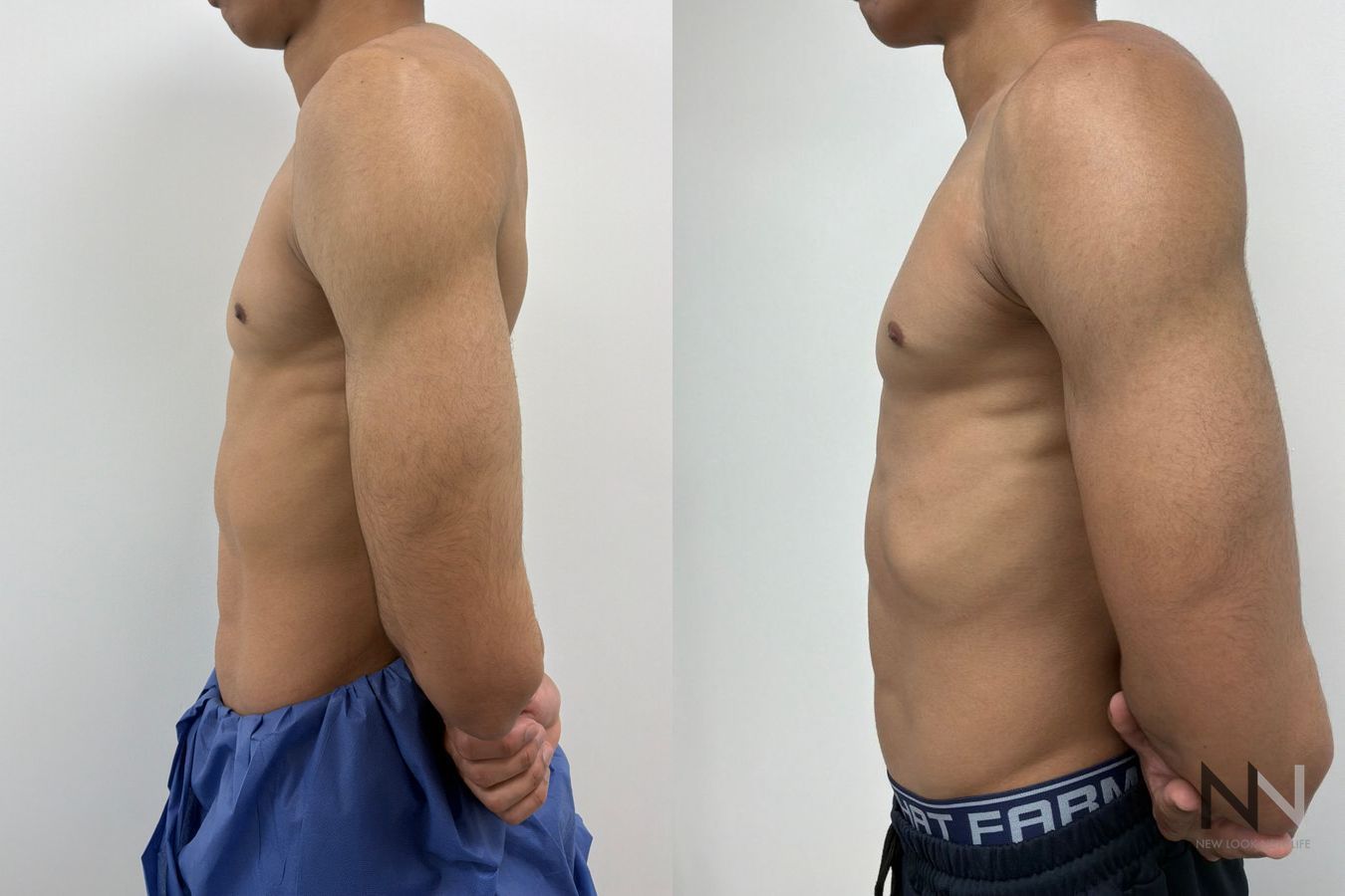 Gynecomastia surgery before and after showing improved male chest contour and symmetry following glandular tissue excision by Dr. Claudia Kim in NYC - Angle 3