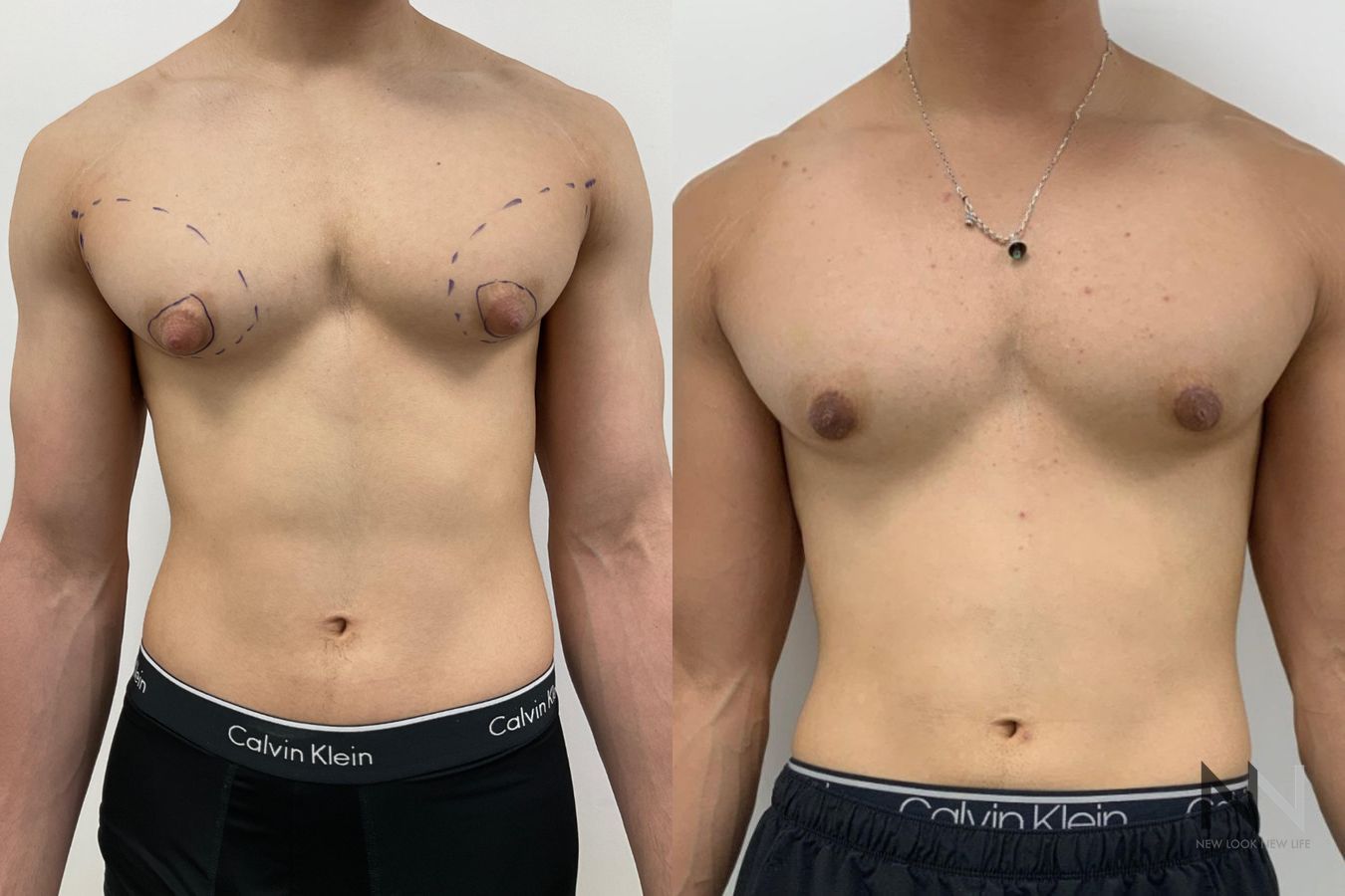 Before and after gynecomastia surgery four months results