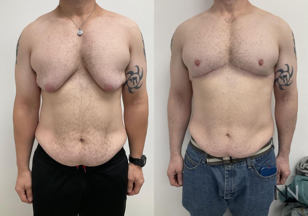 Before and after gynecomastia lift showing reduced male breast tissue and improved chest contour four months after surgery.