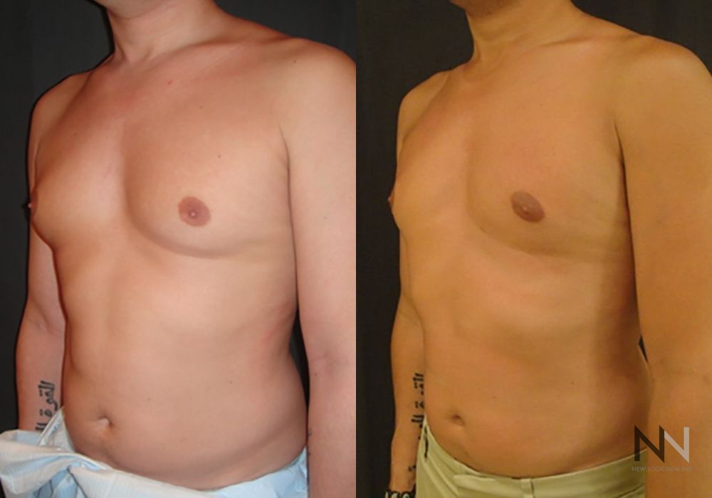 Before and after gynecomastia surgery showing male chest reduction and flatter contour at four months post-operation. - Angle 2