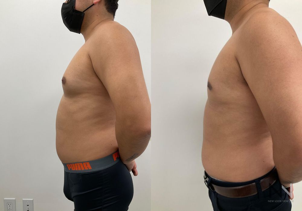 Gynecomastia - Thumbnail 3