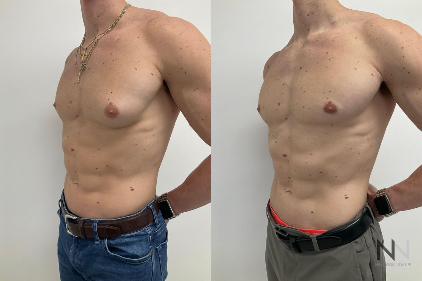 Gynecomastia before and after frontal view comparison - Angle 4