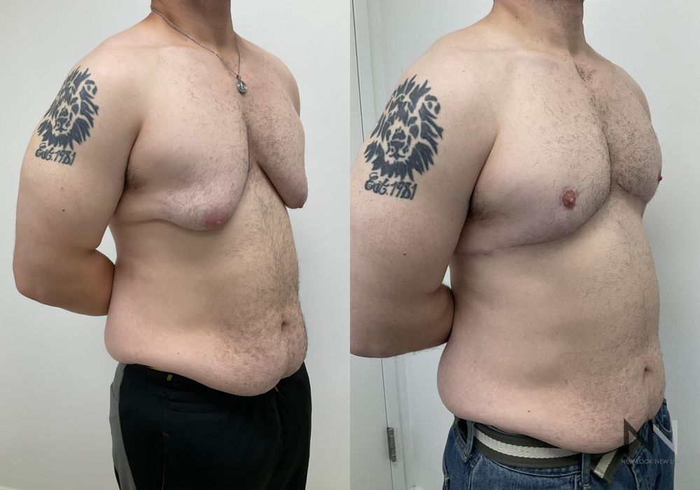 Before and after gynecomastia lift showing reduced male breast tissue and improved chest contour four months after surgery. - Angle 4