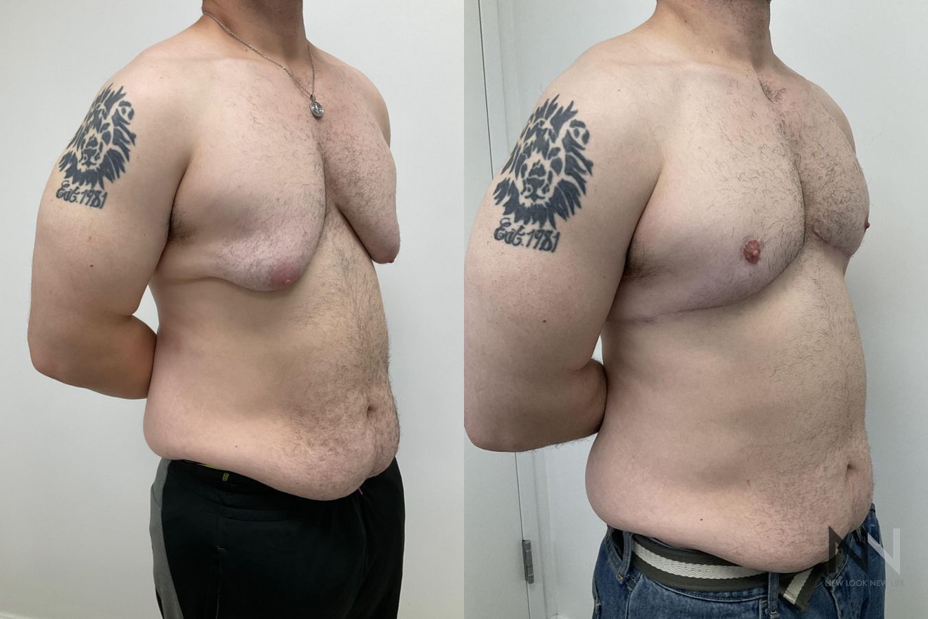 Before and after gynecomastia lift showing reduced male breast tissue and improved chest contour four months after surgery. - Angle 4