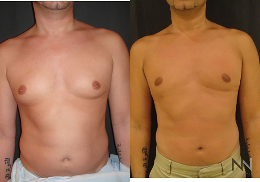 Gynecomastia - Case 2293