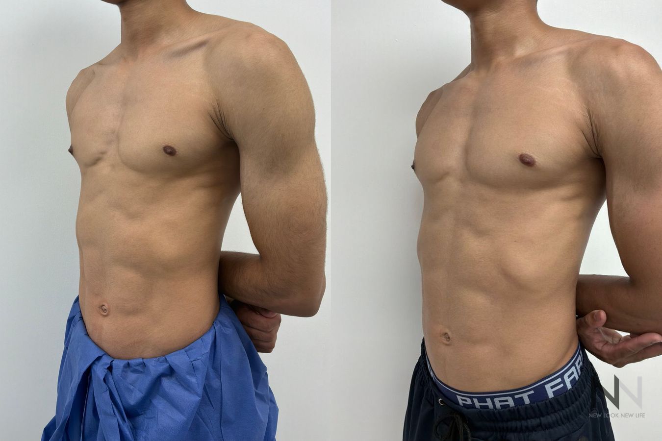 Gynecomastia surgery before and after showing improved male chest contour and symmetry following glandular tissue excision by Dr. Claudia Kim in NYC - Angle 4