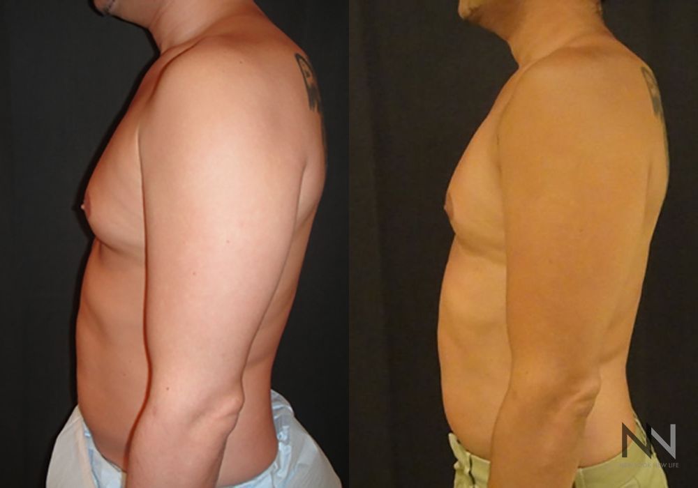 Gynecomastia - Thumbnail 3