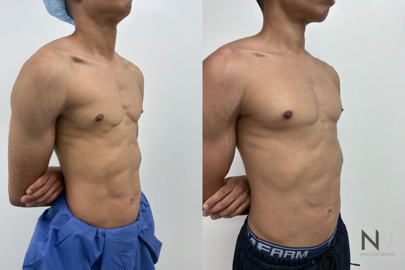 Gynecomastia surgery before and after showing improved male chest contour and symmetry following glandular tissue excision by Dr. Claudia Kim in NYC - Angle 2