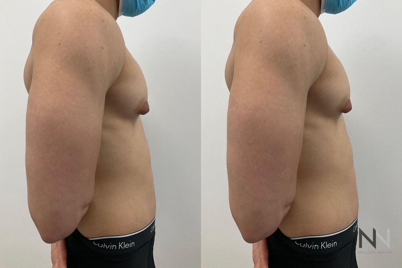 Before and after gynecomastia surgery four months results - Angle 3