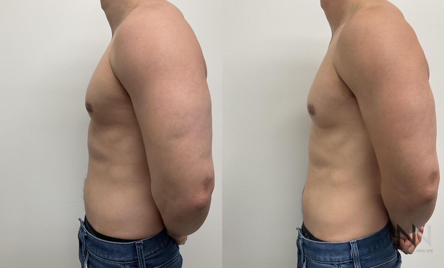 Gynecomastia surgery showing flatter chest contour - Angle 4