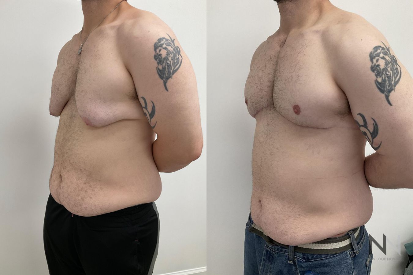 Before and after gynecomastia lift showing reduced male breast tissue and improved chest contour four months after surgery. - Angle 3