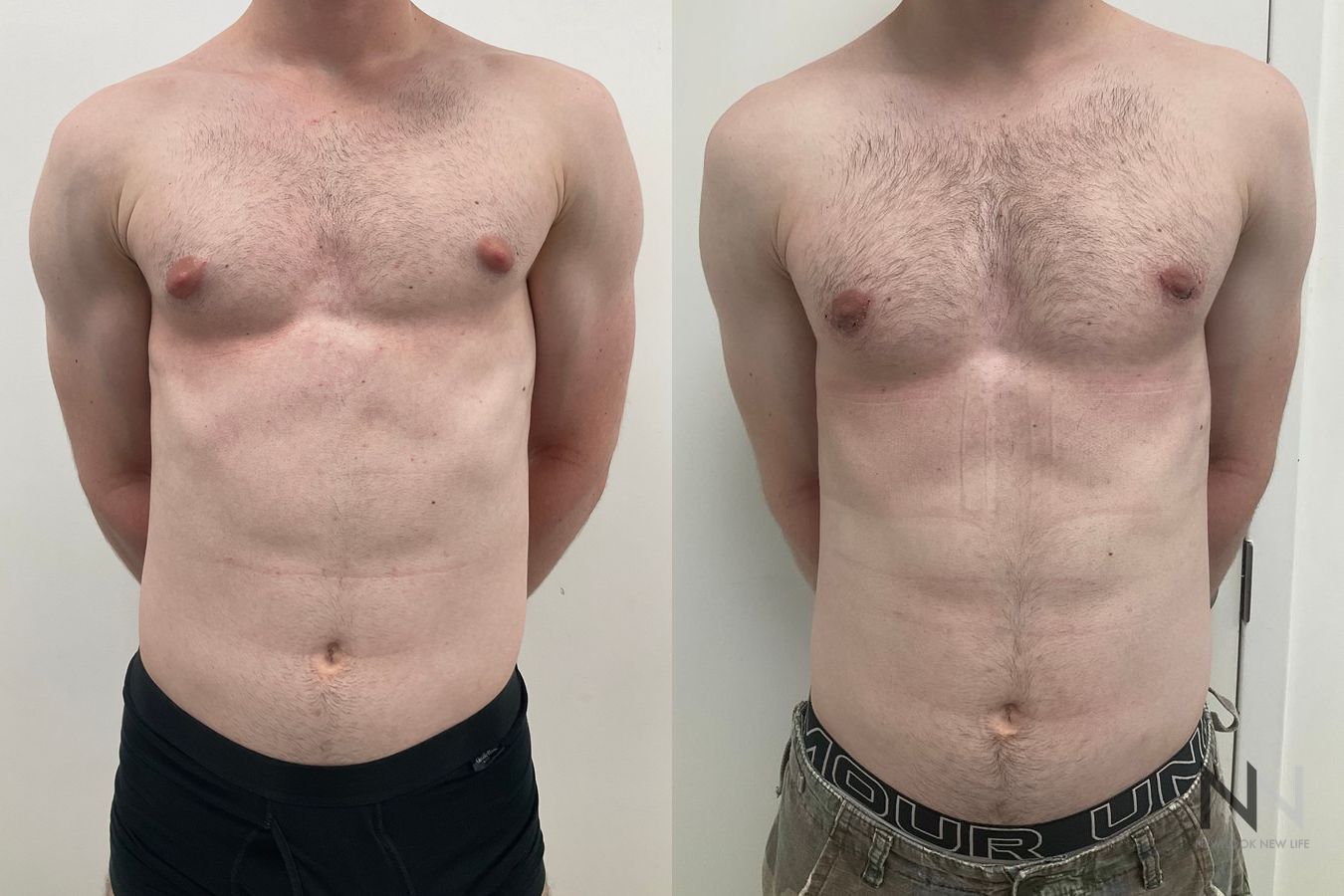 Before-and-after photos of gynecomastia surgery performed by Dr. Claudia Kim, showcasing male chest contouring with improved definition, symmetry, and a flatter chest appearance. - Angle 2
