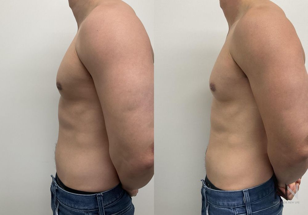 Gynecomastia - Thumbnail 3