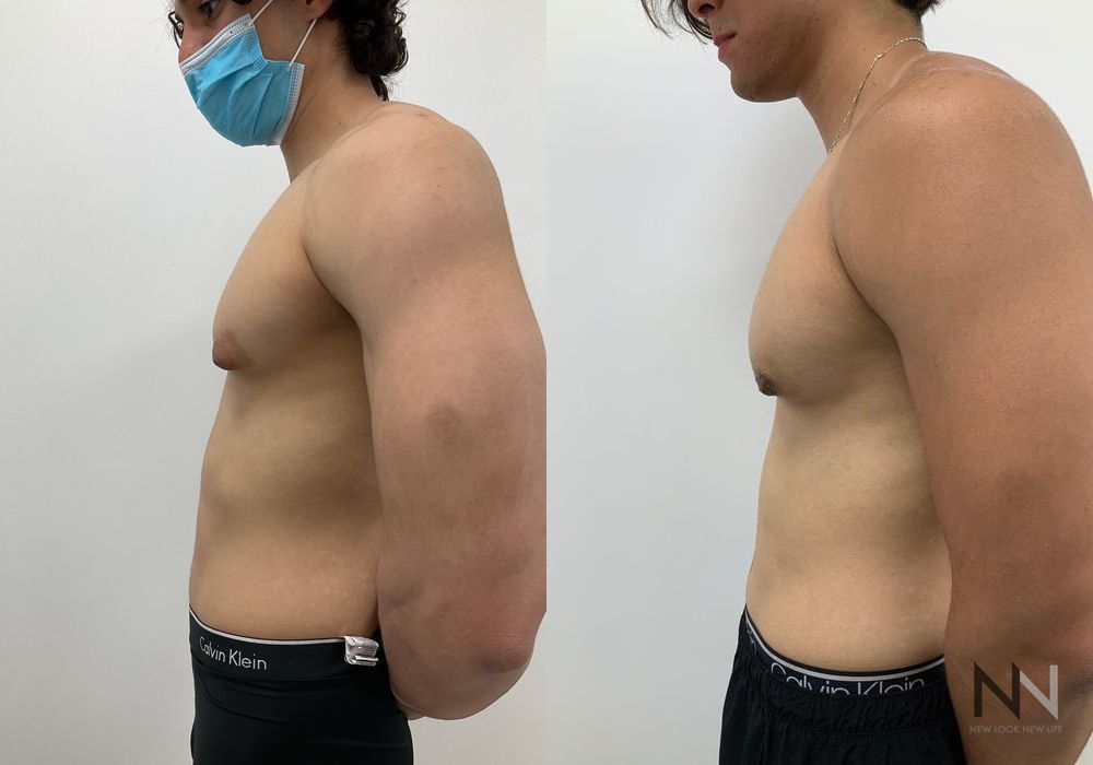 Gynecomastia - Thumbnail 5