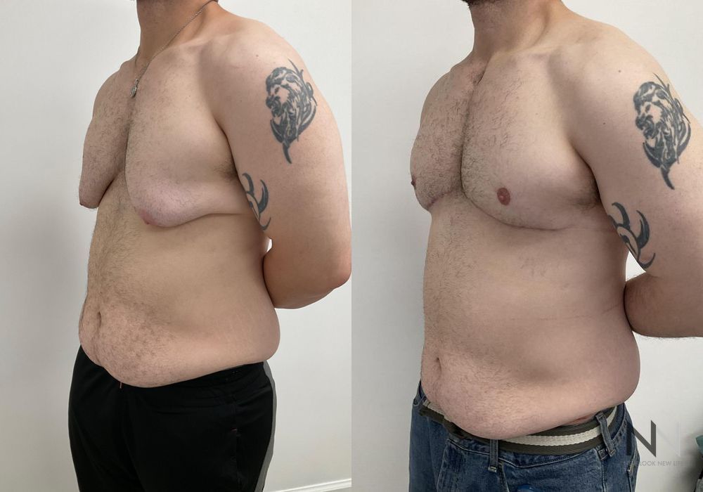 Before and after gynecomastia lift showing reduced male breast tissue and improved chest contour four months after surgery. - Angle 3