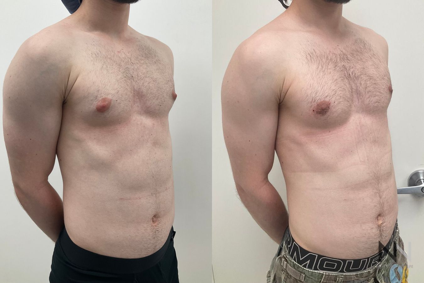 Before-and-after photos of gynecomastia surgery performed by Dr. Claudia Kim, showcasing male chest contouring with improved definition, symmetry, and a flatter chest appearance.