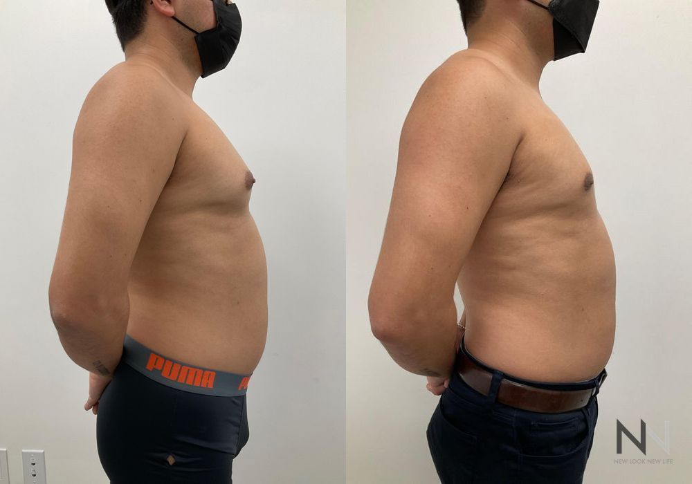 Gynecomastia - Thumbnail 5