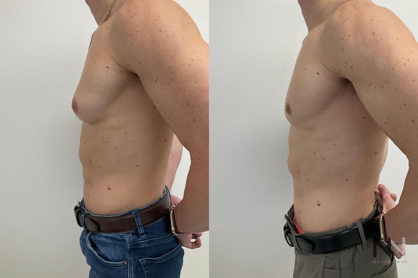 Gynecomastia before and after frontal view comparison - Angle 5