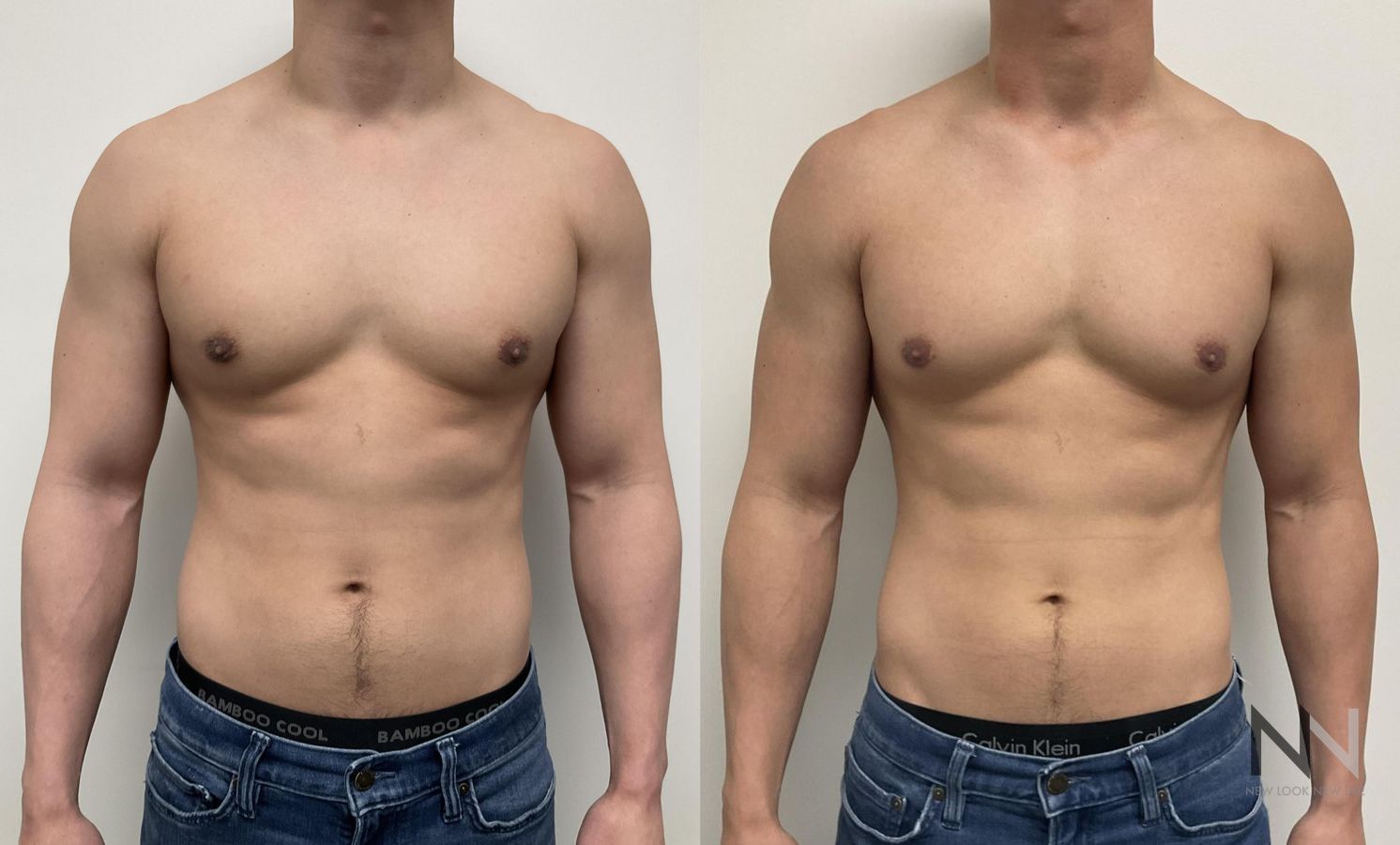 Gynecomastia surgery showing flatter chest contour