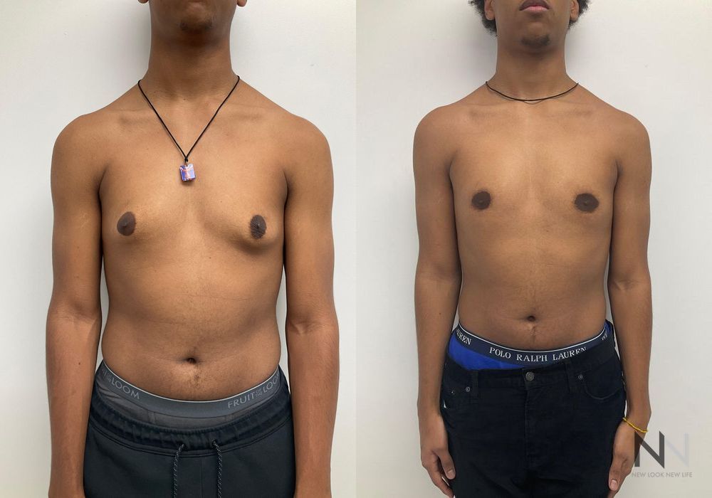 Gynecomastia - Case 2288