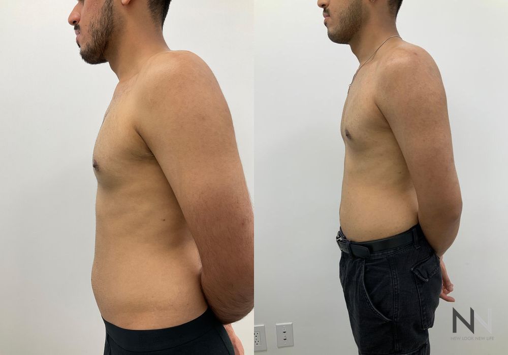 Gynecomastia - Thumbnail 5