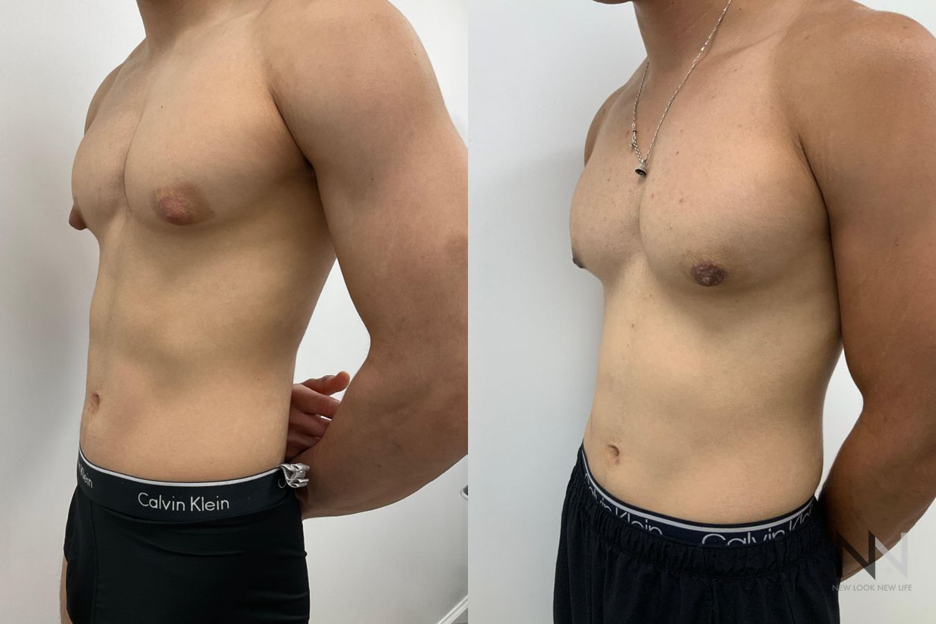 Before and after gynecomastia surgery four months results - Angle 4