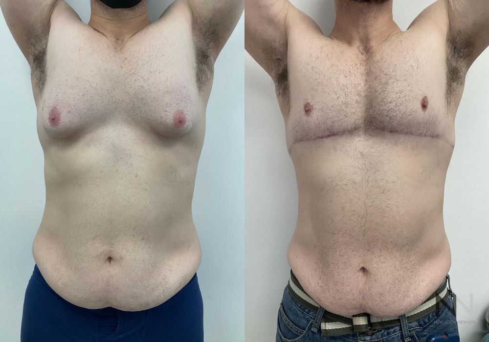 Before and after gynecomastia lift showing reduced male breast tissue and improved chest contour four months after surgery. - Angle 2