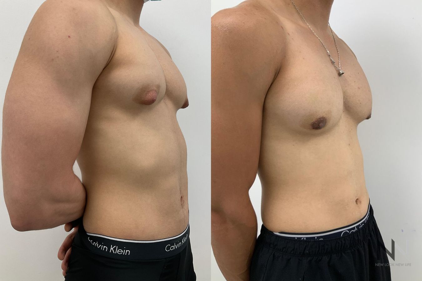 Before and after gynecomastia surgery four months results - Angle 2
