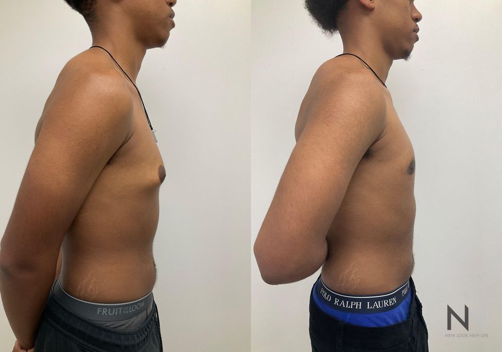 Gynecomastia - Thumbnail 3