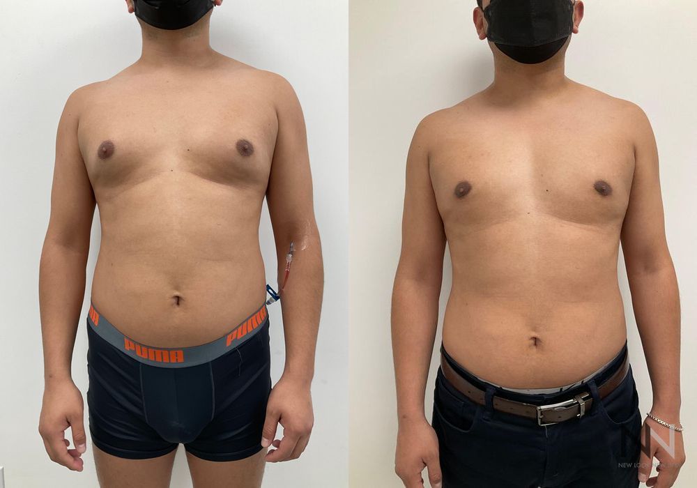 Gynecomastia - Case 2289