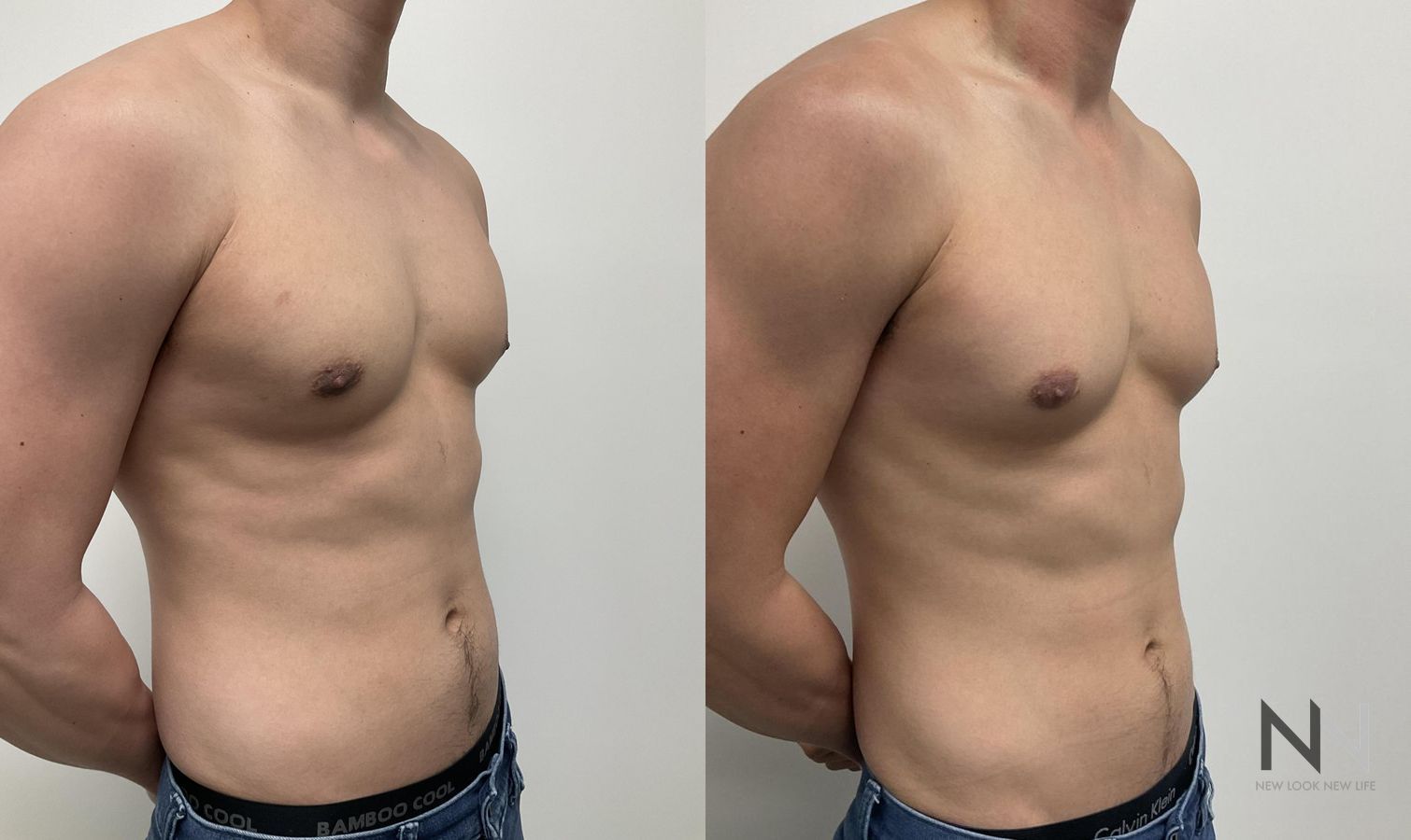 Gynecomastia surgery showing flatter chest contour - Angle 5