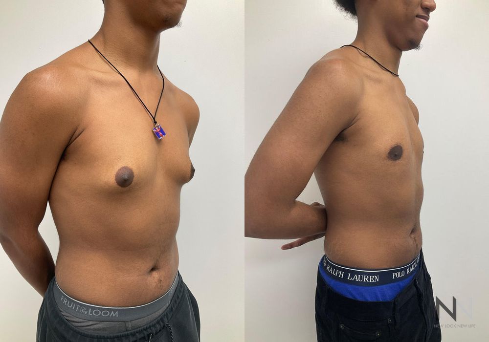 Gynecomastia - Thumbnail 2