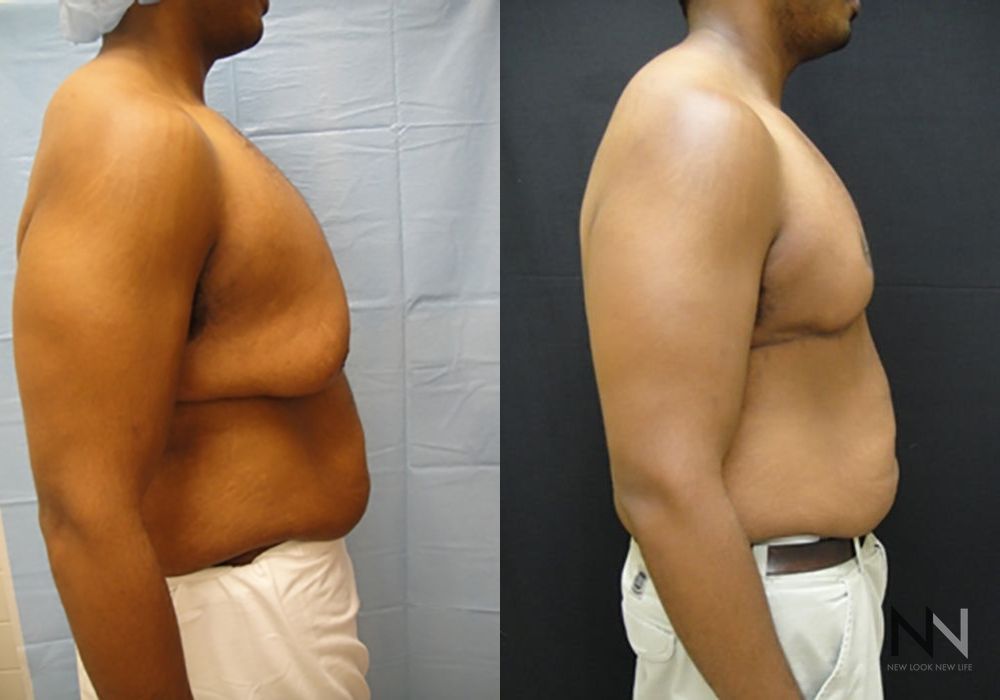 Gynecomastia - Thumbnail 5