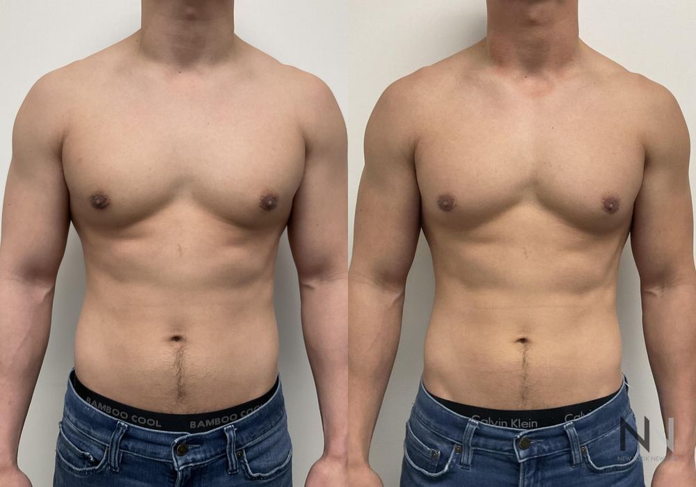 Gynecomastia - Thumbnail 6