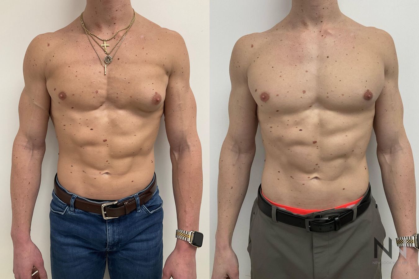 Gynecomastia before and after frontal view comparison