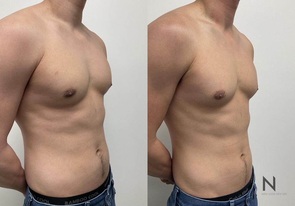 Gynecomastia - Thumbnail 4