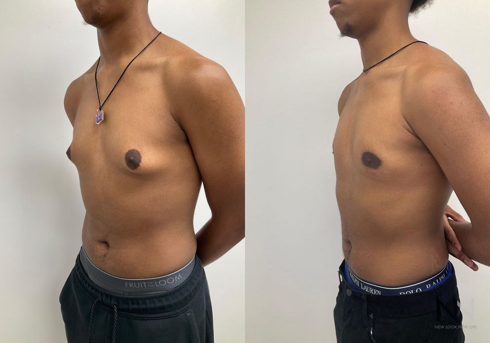 Gynecomastia - Thumbnail 4