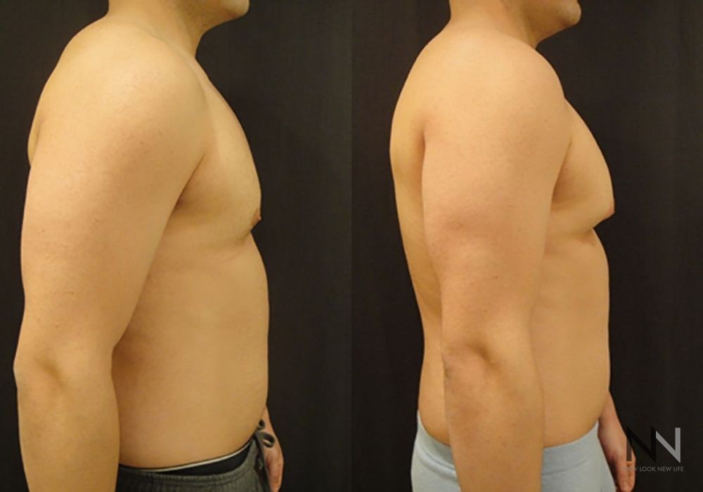 Gynecomastia - Thumbnail 3