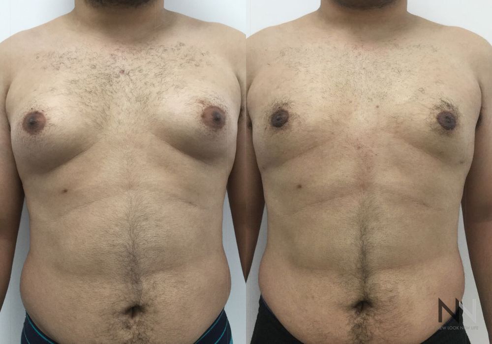 Gynecomastia - Case 1751