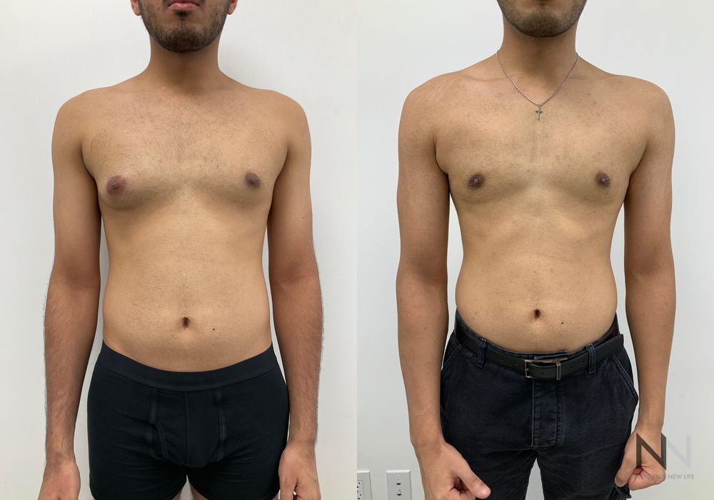Gynecomastia - Case 1758